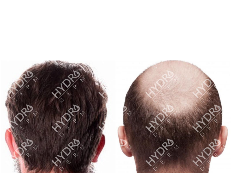 انواع روش های کاشت مو